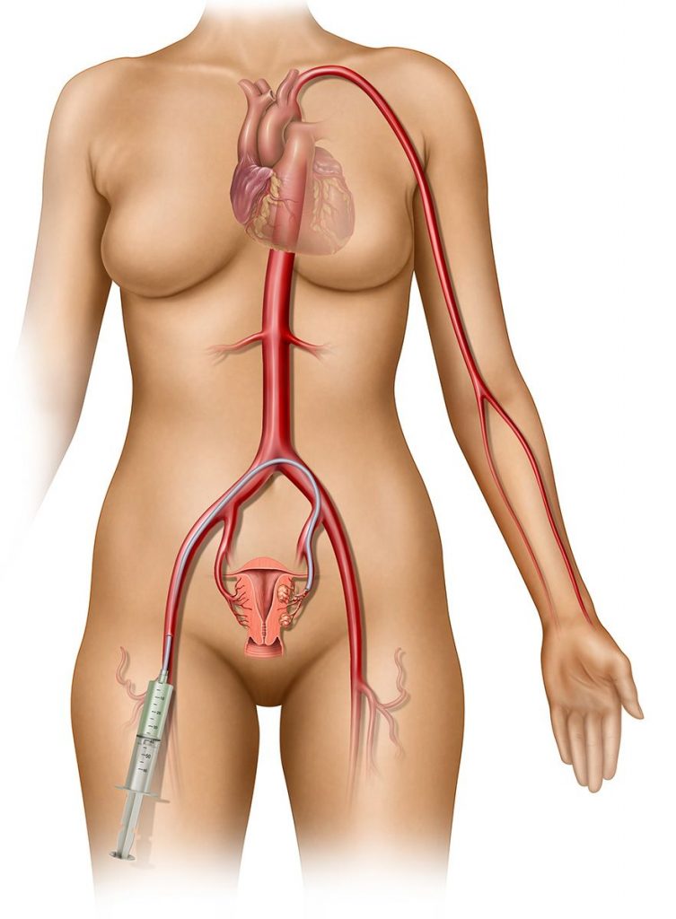 embolização de mioma uterino